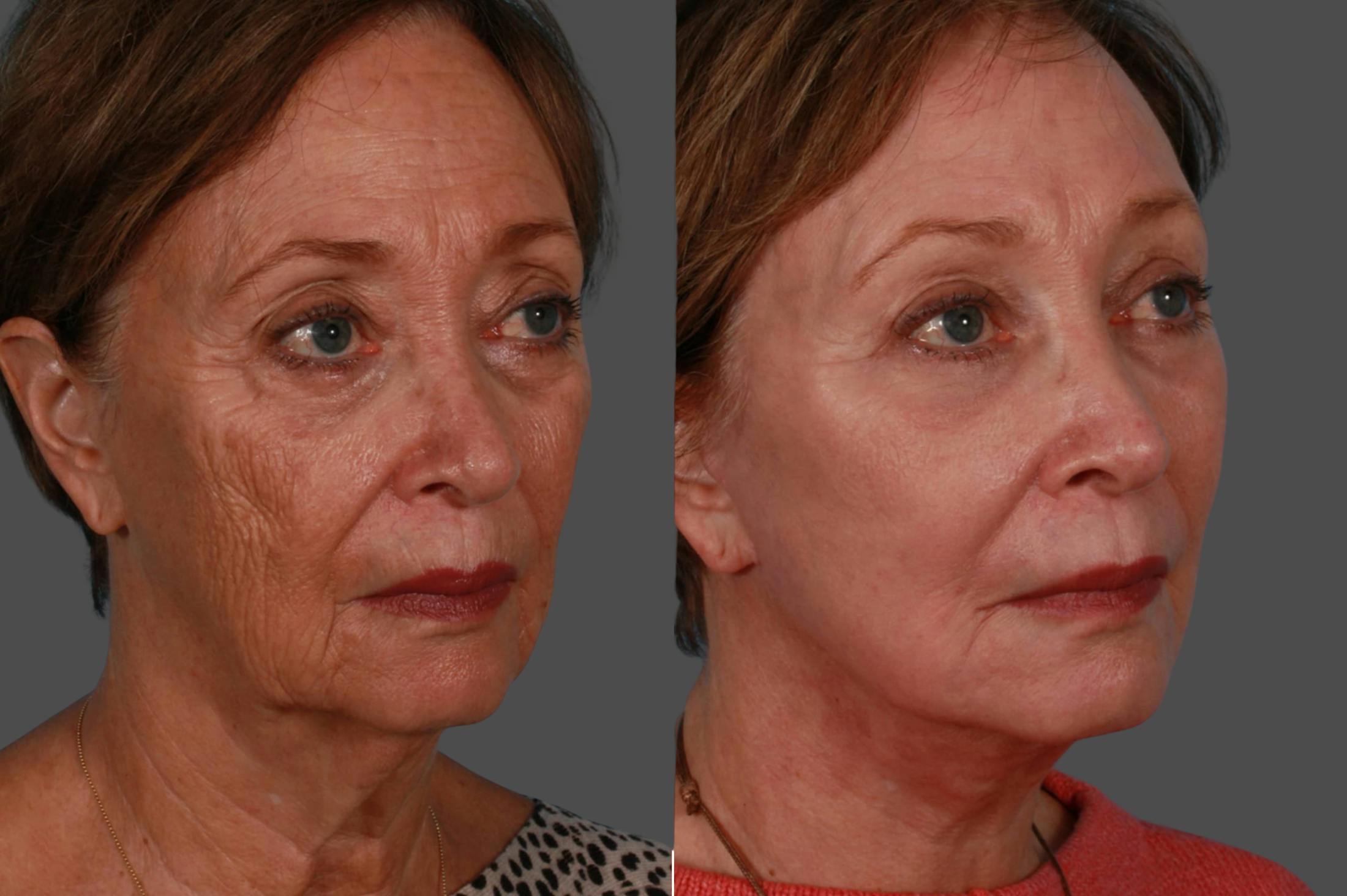Eyelid Surgery (Blepharoplasty) Before & After Gallery - Patient 138534 - Image 2