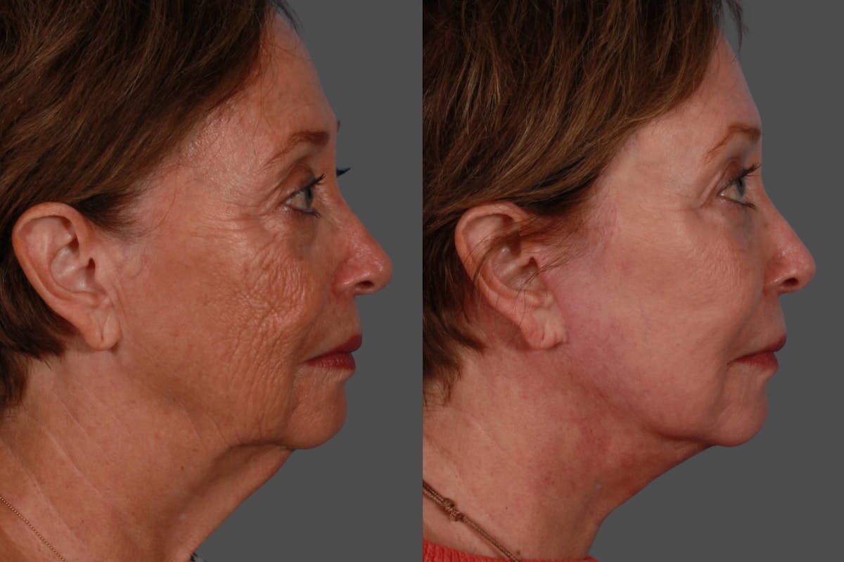 Eyelid Surgery (Blepharoplasty) Before & After Gallery - Patient 138534 - Image 3