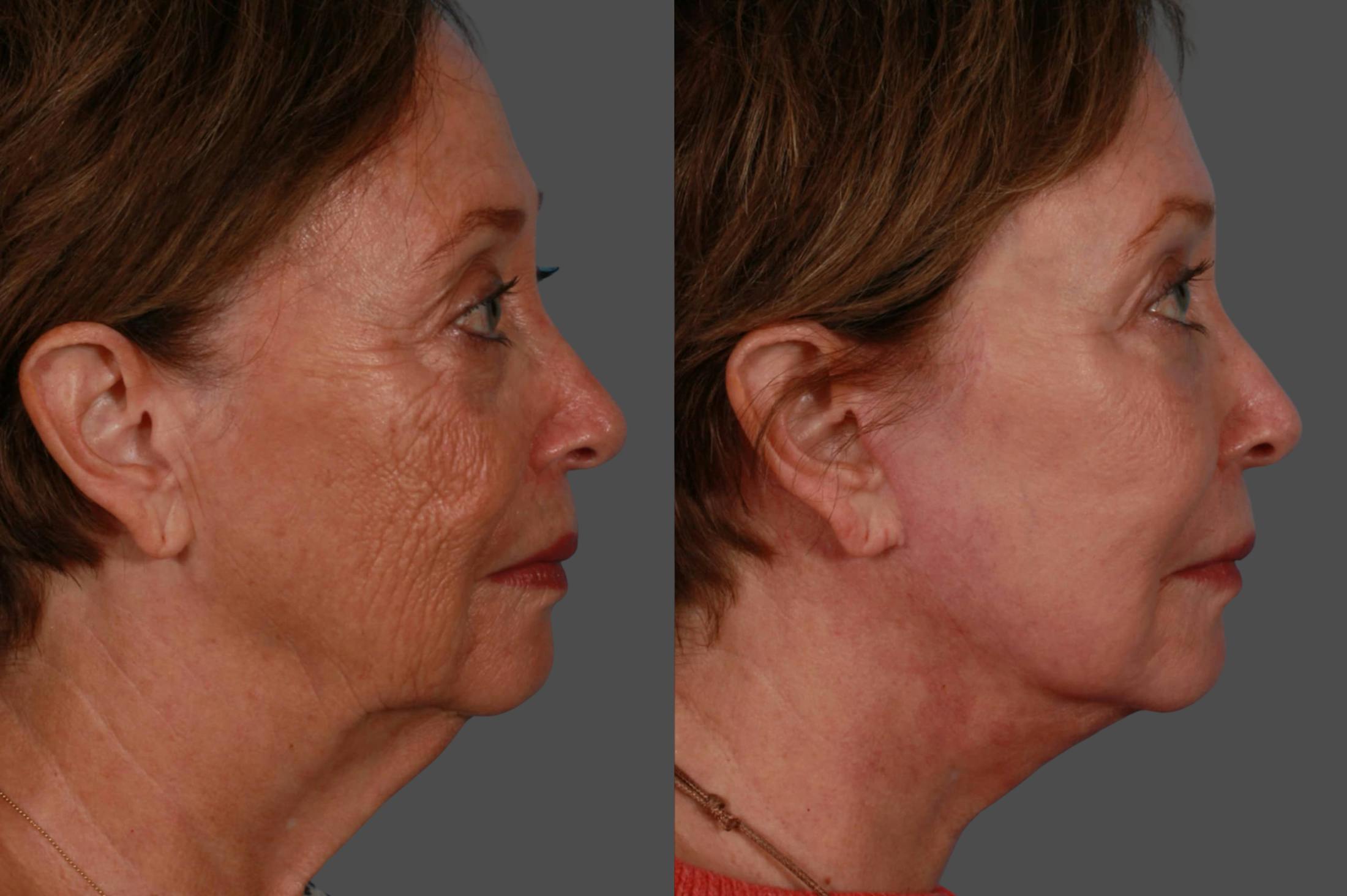 Eyelid Surgery (Blepharoplasty) Before & After Gallery - Patient 138534 - Image 3