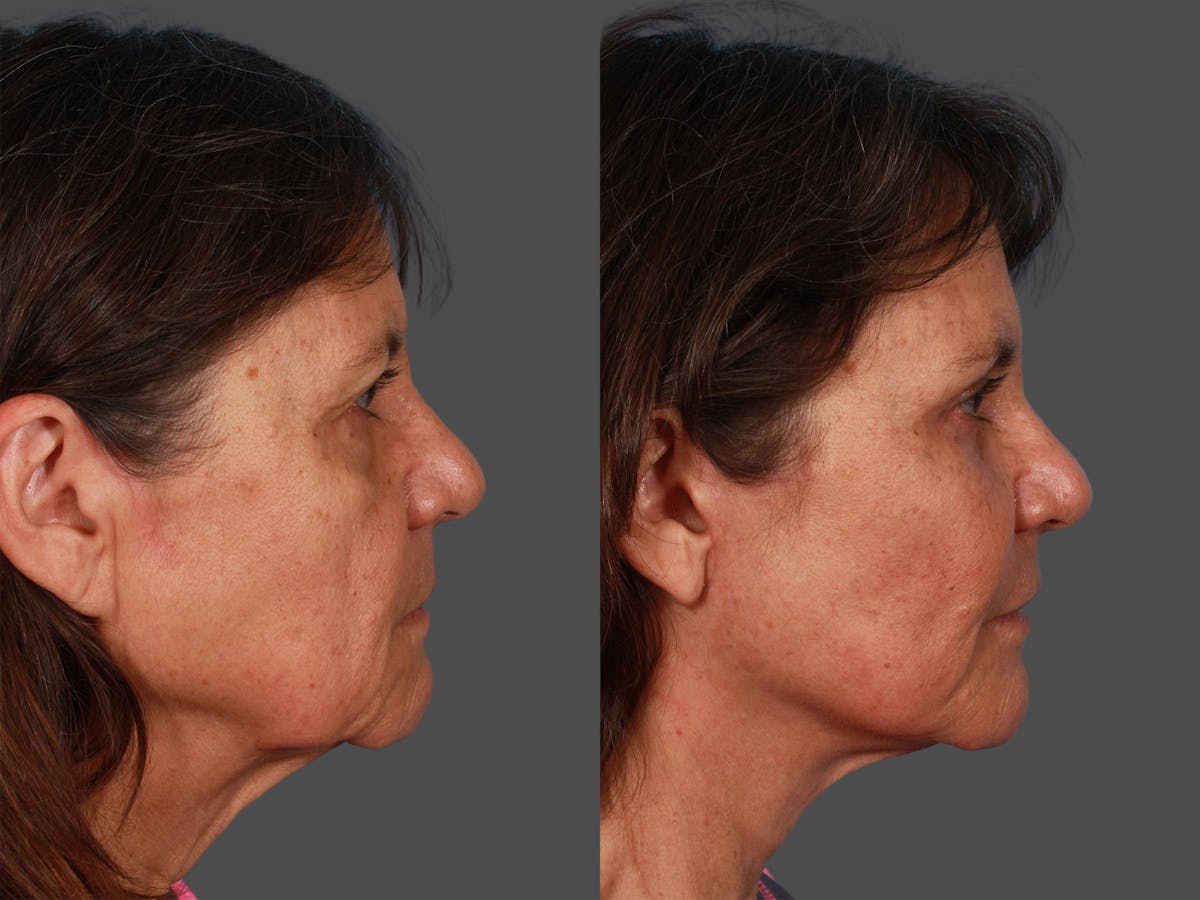 Facial Fat Transfer Before & After Gallery - Patient 359775 - Image 2