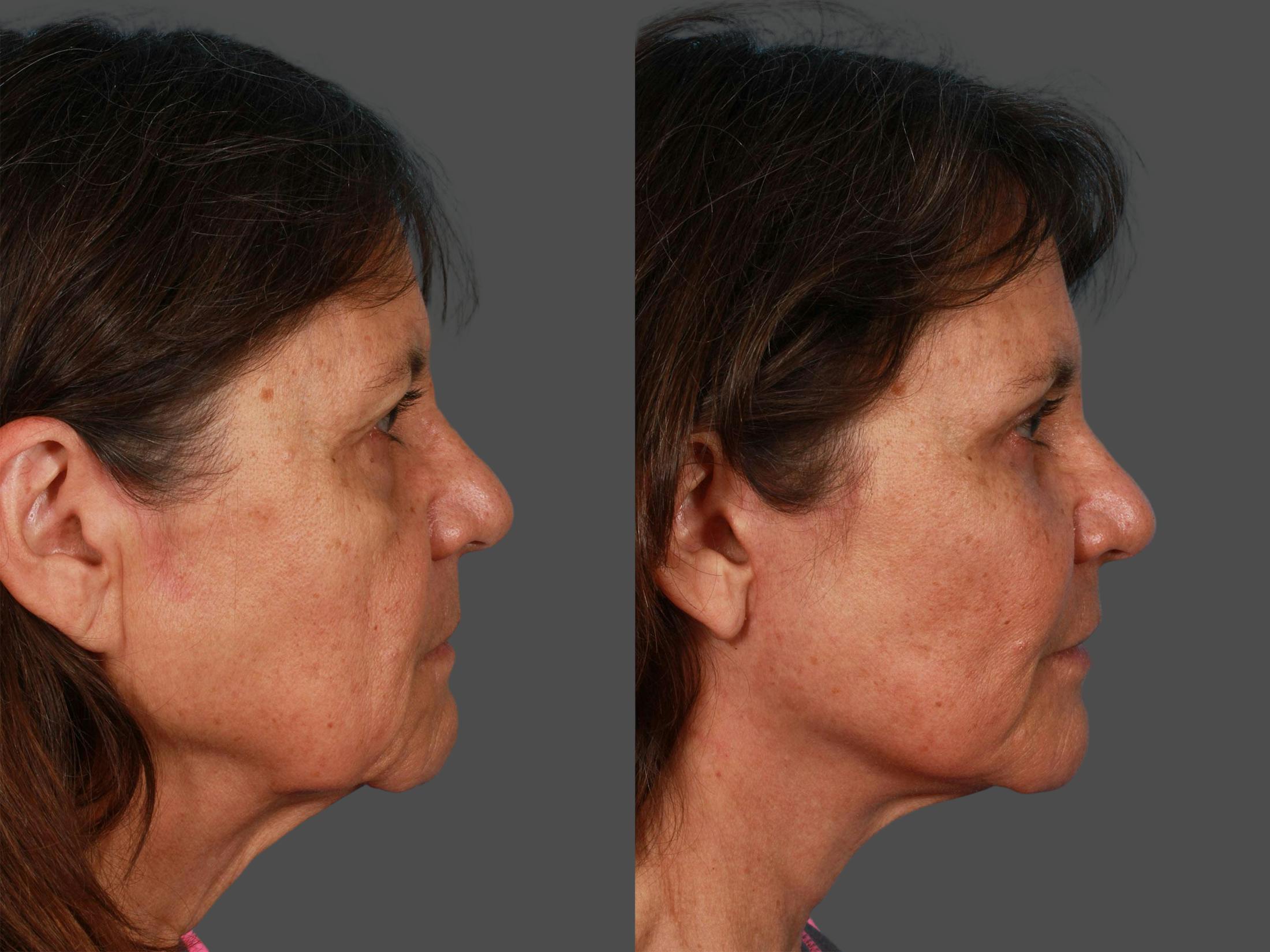 Facial Fat Transfer Before & After Gallery - Patient 359775 - Image 2