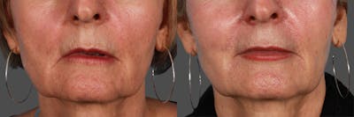 JUVEDERM® Before & After Gallery - Patient 129224 - Image 1