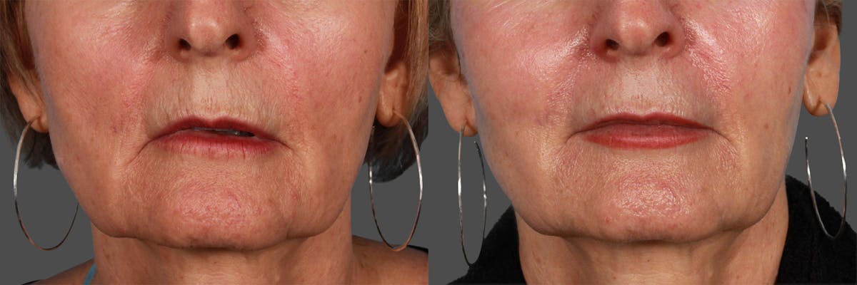 JUVEDERM® Before & After Gallery - Patient 129224 - Image 1