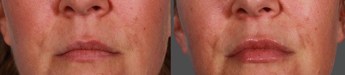 JUVEDERM® Before & After Gallery - Patient 146305 - Image 1