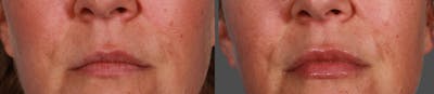 JUVEDERM® Before & After Gallery - Patient 146305 - Image 1