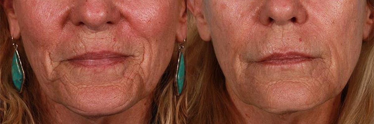 JUVEDERM® Before & After Gallery - Patient 133846 - Image 1