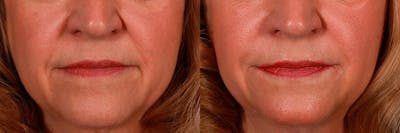 JUVEDERM® Before & After Gallery - Patient 270139 - Image 1