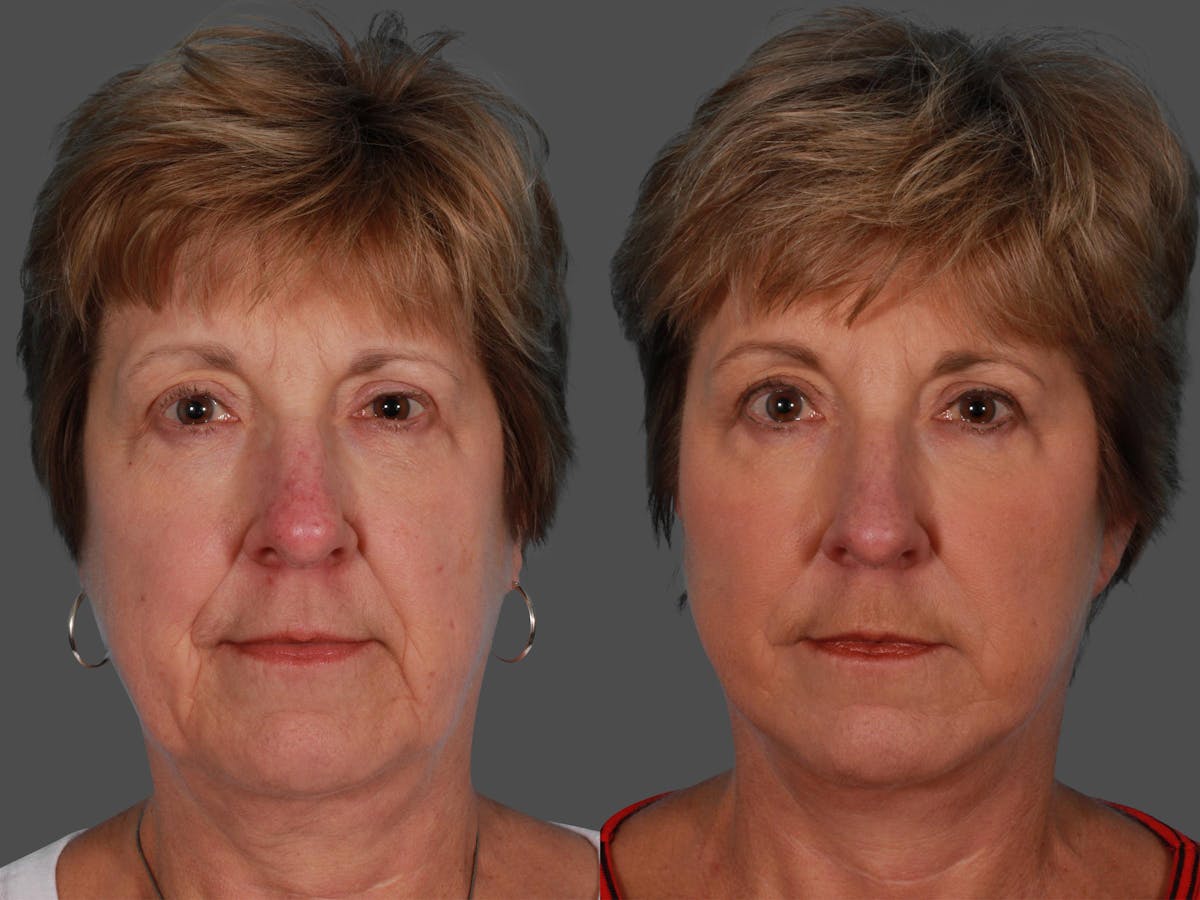 JUVEDERM® Before & After Gallery - Patient 338278 - Image 1