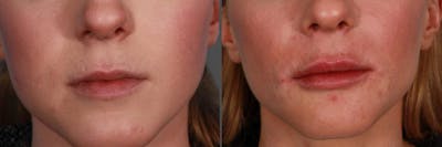 JUVEDERM® Before & After Gallery - Patient 365331 - Image 1