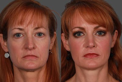 JUVEDERM® Before & After Gallery - Patient 510522 - Image 1