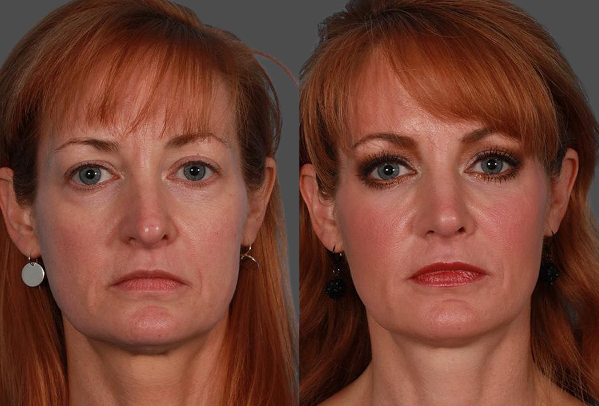 JUVEDERM® Before & After Gallery - Patient 510522 - Image 1