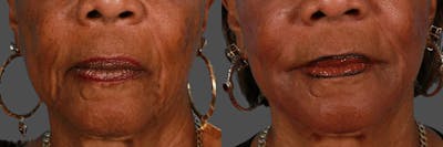 JUVEDERM® Before & After Gallery - Patient 308267 - Image 1