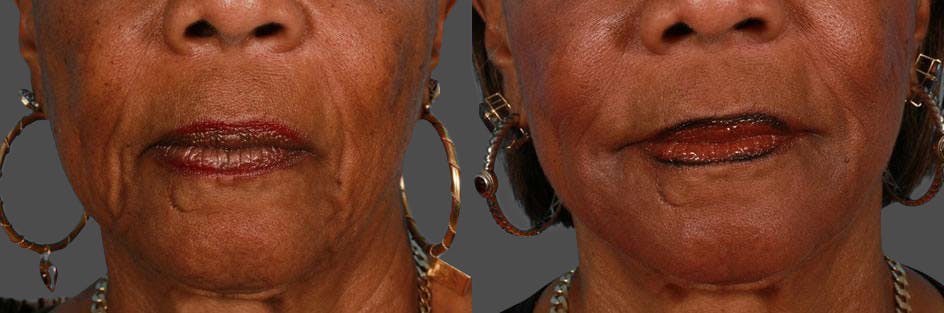JUVEDERM® Before & After Gallery - Patient 308267 - Image 1