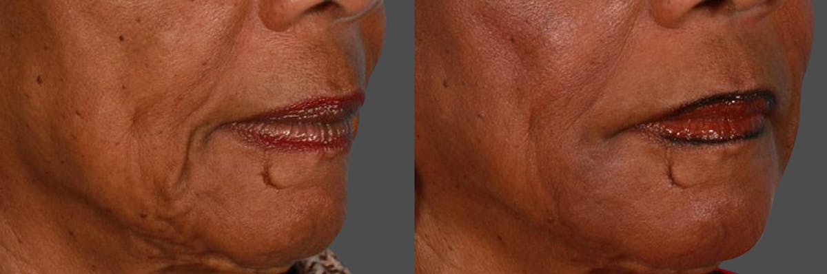 JUVEDERM® Before & After Gallery - Patient 308267 - Image 2