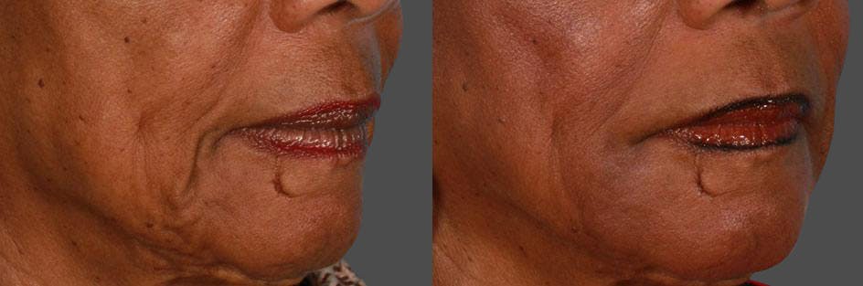 JUVEDERM® Before & After Gallery - Patient 308267 - Image 2