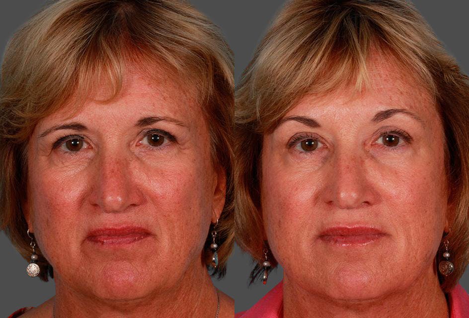JUVEDERM® Before & After Gallery - Patient 240514 - Image 1