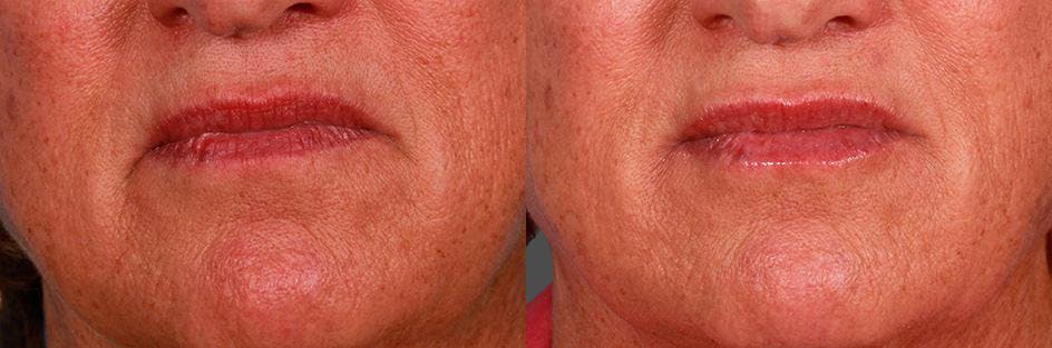 JUVEDERM® Before & After Gallery - Patient 240514 - Image 3
