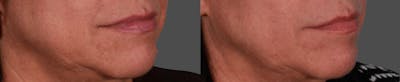 JUVEDERM® Before & After Gallery - Patient 236655 - Image 1