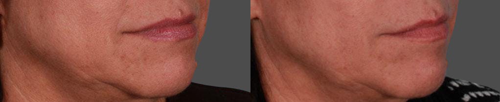JUVEDERM® Before & After Gallery - Patient 236655 - Image 1