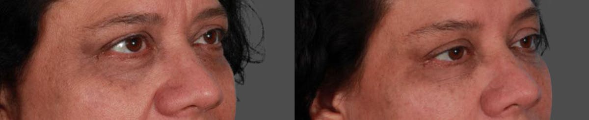 JUVEDERM® Before & After Gallery - Patient 236655 - Image 2
