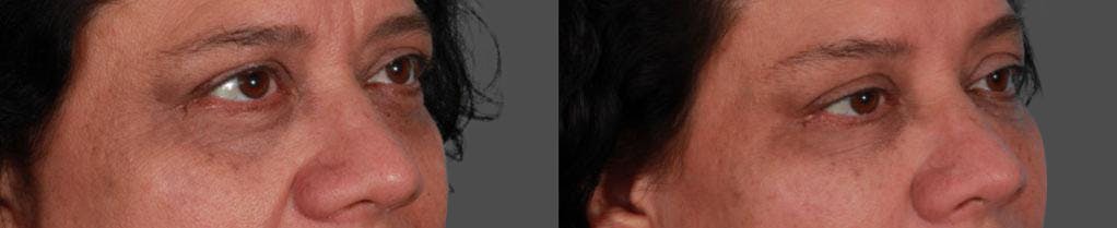 JUVEDERM® Before & After Gallery - Patient 236655 - Image 2