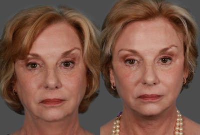 Facelift Before & After Gallery - Patient 175212 - Image 1