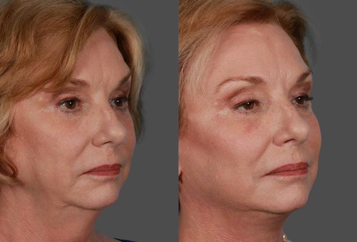 Facelift Before & After Gallery - Patient 175212 - Image 2