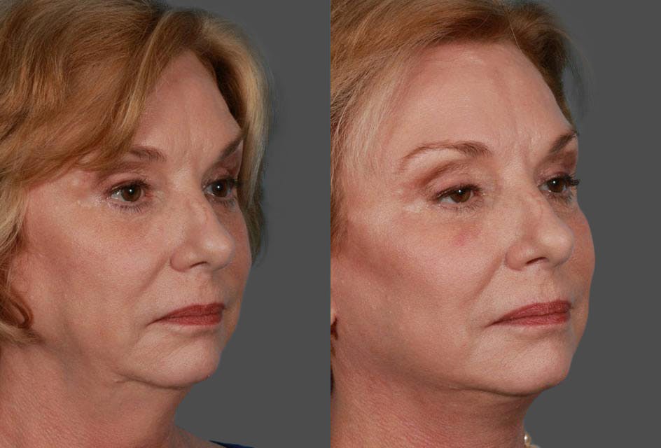 Facelift Before & After Gallery - Patient 175212 - Image 2