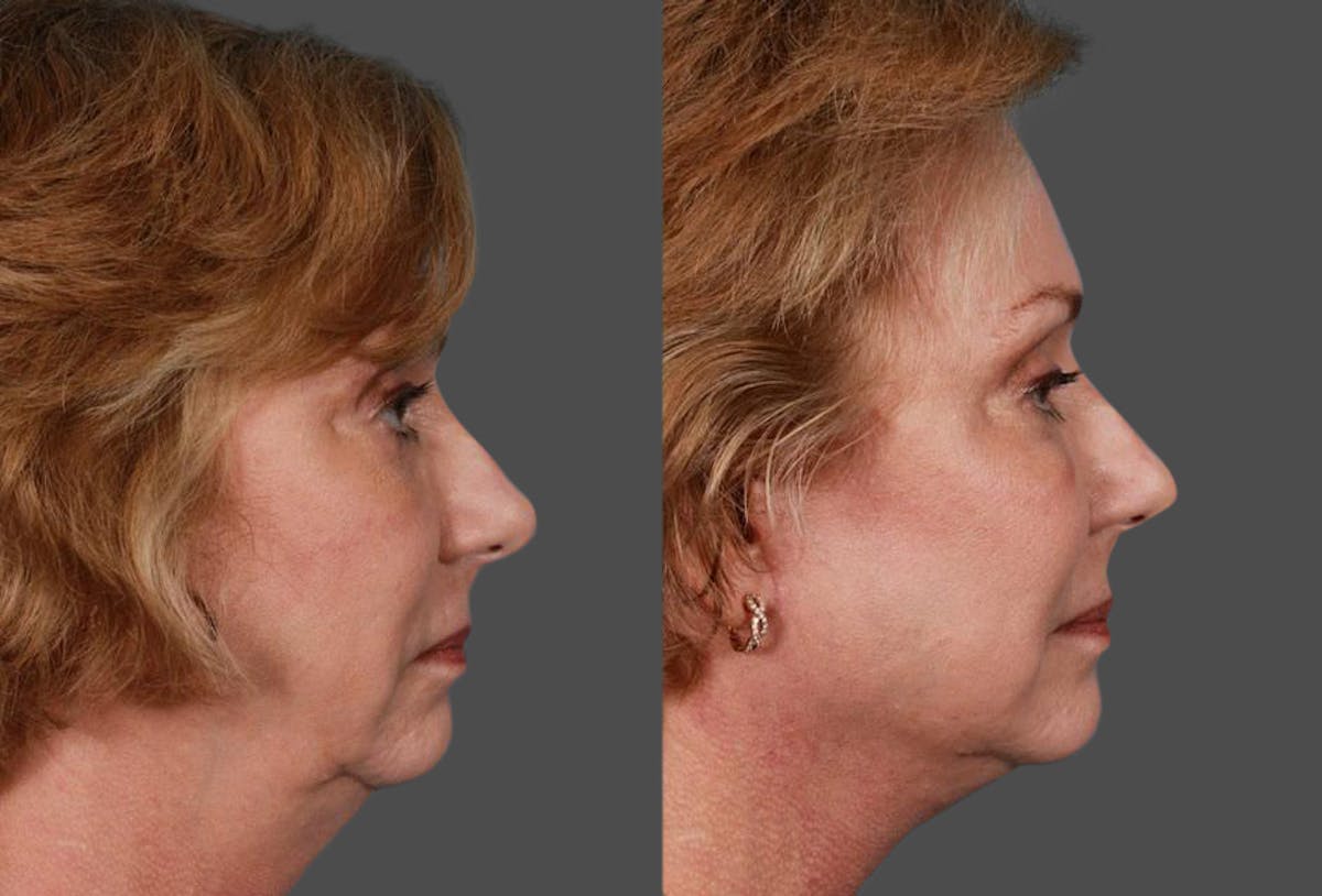 Facelift Before & After Gallery - Patient 175212 - Image 3