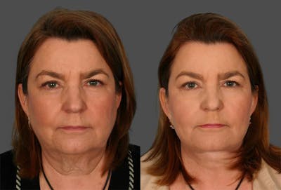 Facelift Before & After Gallery - Patient 169490 - Image 1