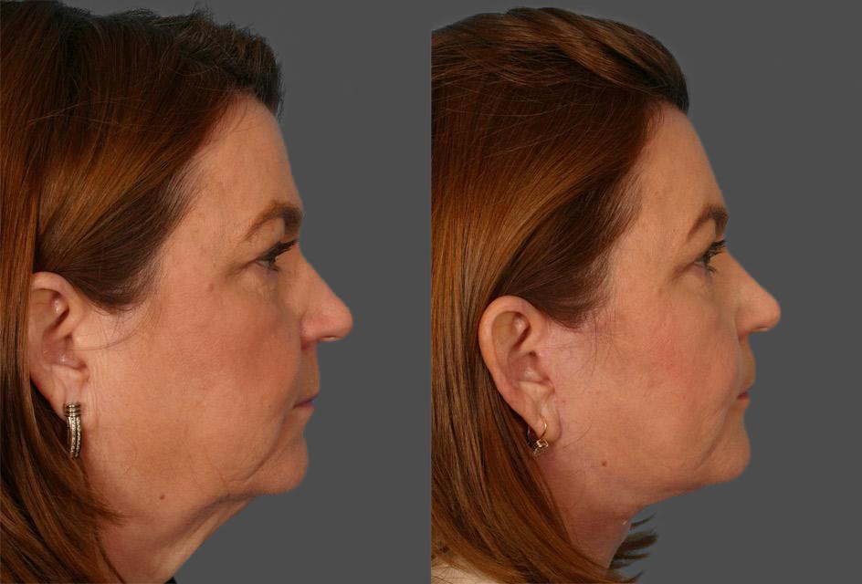 Facelift Before & After Gallery - Patient 169490 - Image 2