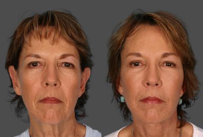 Facelift Before & After Gallery - Patient 147692 - Image 1