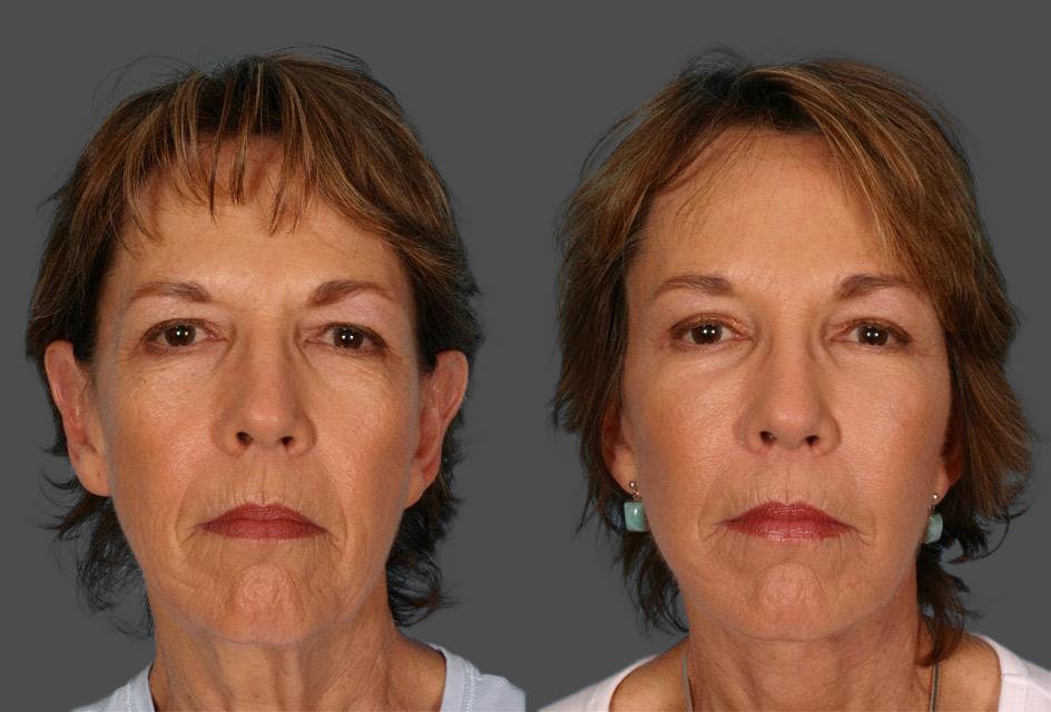 Facelift Before & After Gallery - Patient 147692 - Image 1