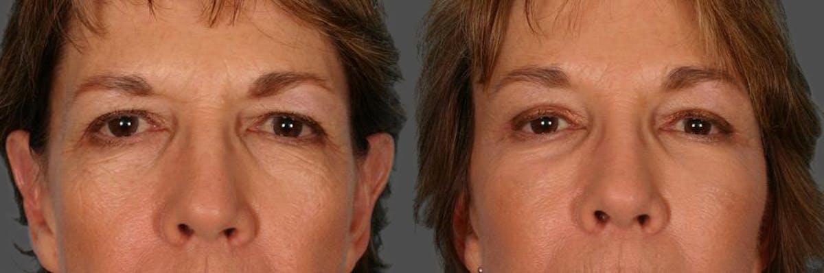 Facelift Before & After Gallery - Patient 147692 - Image 4