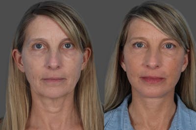 Facelift Before & After Gallery - Patient 133514 - Image 1