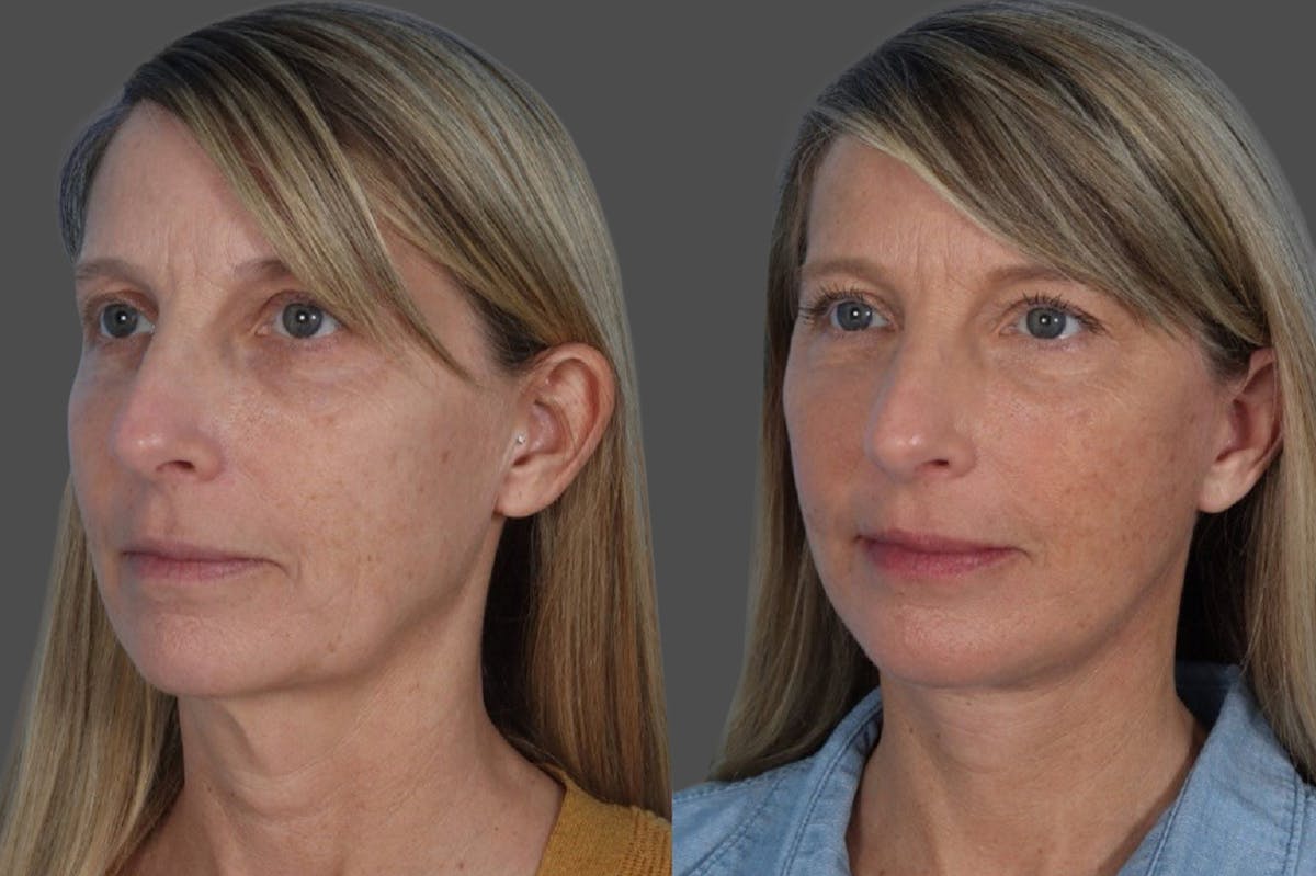 Facelift Before & After Gallery - Patient 133514 - Image 2