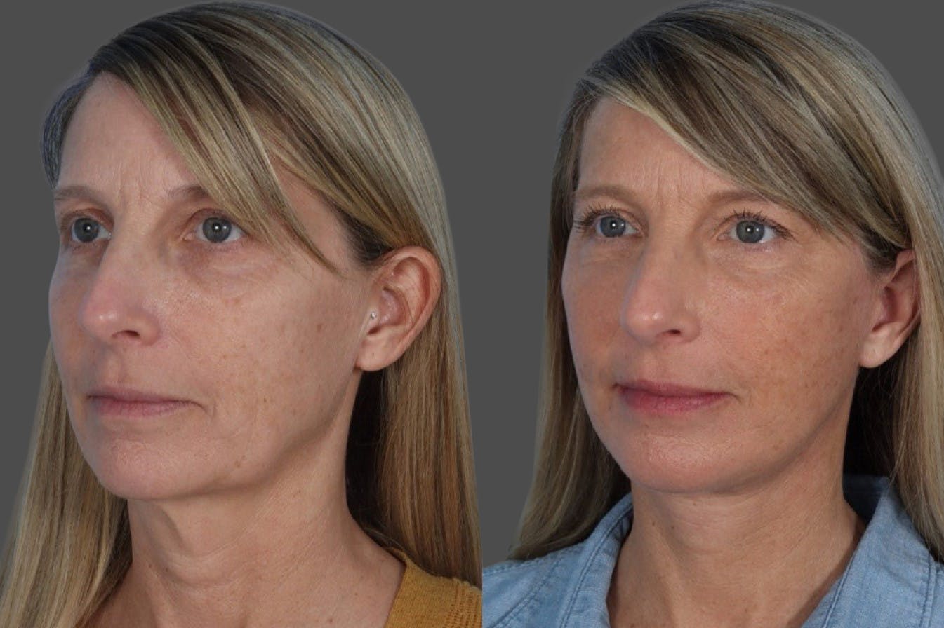 Facelift Before & After Gallery - Patient 133514 - Image 2