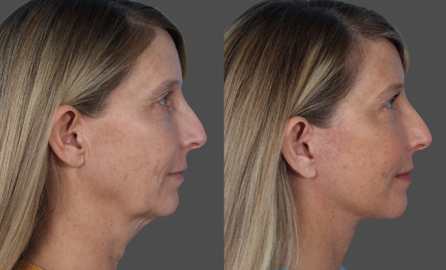 Facelift Before & After Gallery - Patient 133514 - Image 3