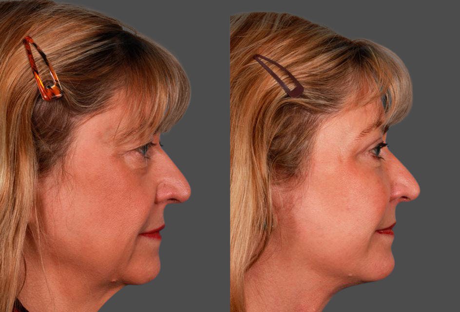 Facelift Before & After Gallery - Patient 123573 - Image 3