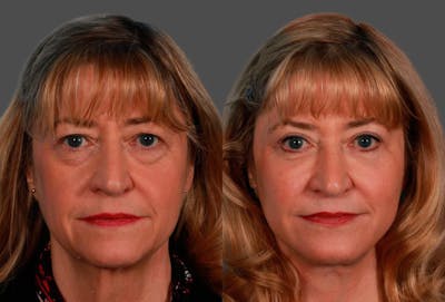 Facelift Before & After Gallery - Patient 123573 - Image 1