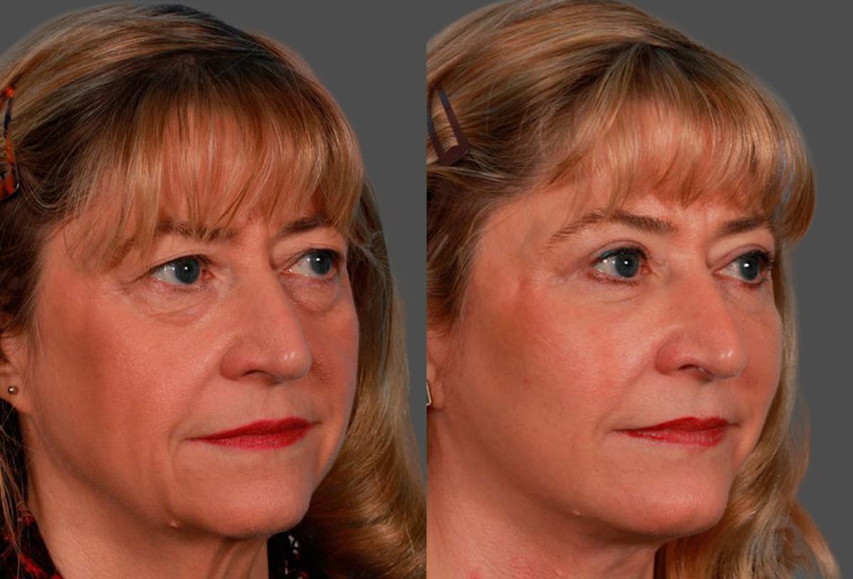 Facelift Before & After Gallery - Patient 123573 - Image 2