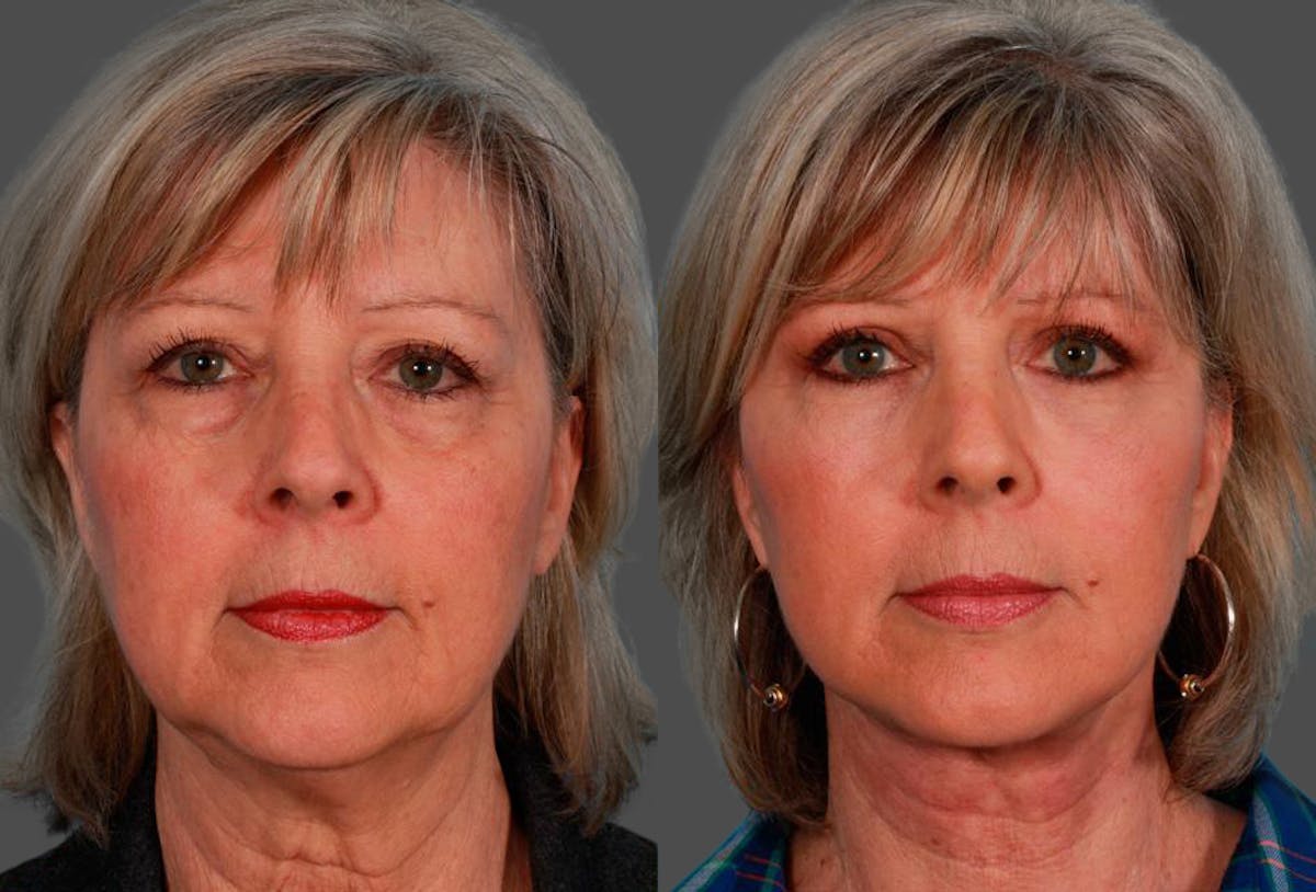 Facial Fat Transfer Before & After Gallery - Patient 786981 - Image 1