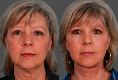 Facelift Before & After Gallery - Patient 205003 - Image 1