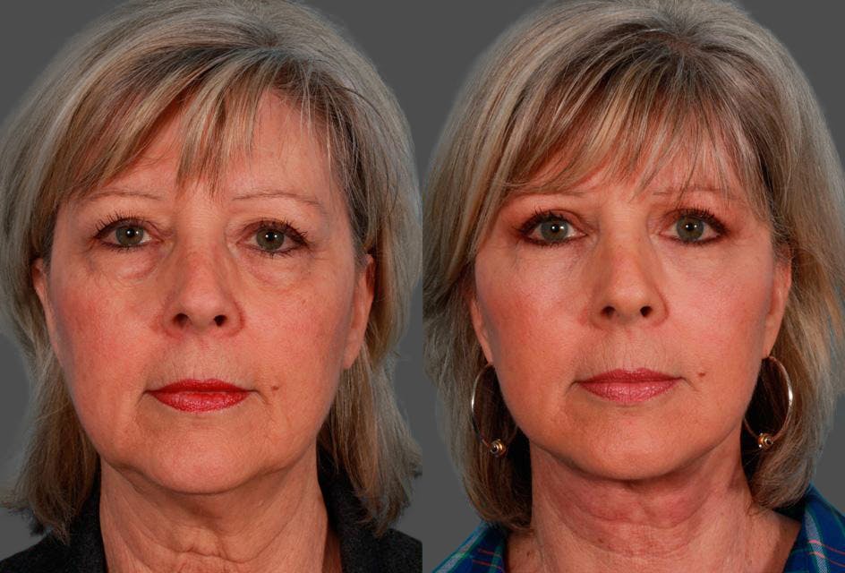 Facial Fat Transfer Before & After Gallery - Patient 786981 - Image 1