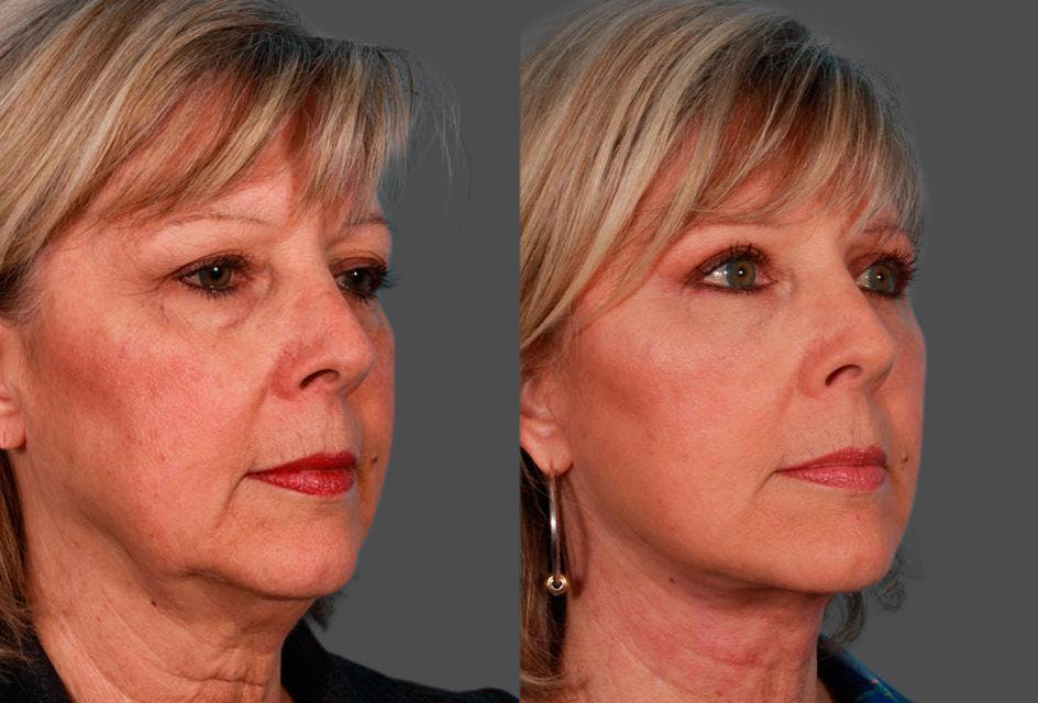 Facial Fat Transfer Before & After Gallery - Patient 786981 - Image 2