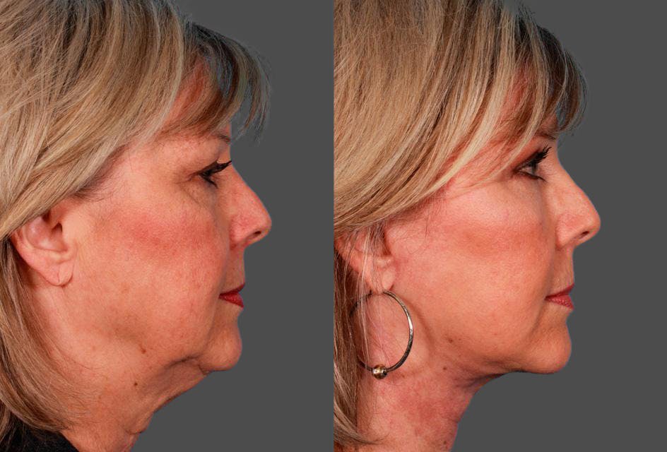 Facial Fat Transfer Before & After Gallery - Patient 786981 - Image 3
