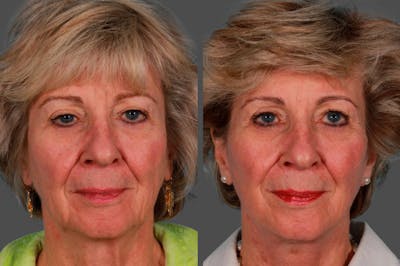 Facelift Before & After Gallery - Patient 181736 - Image 1