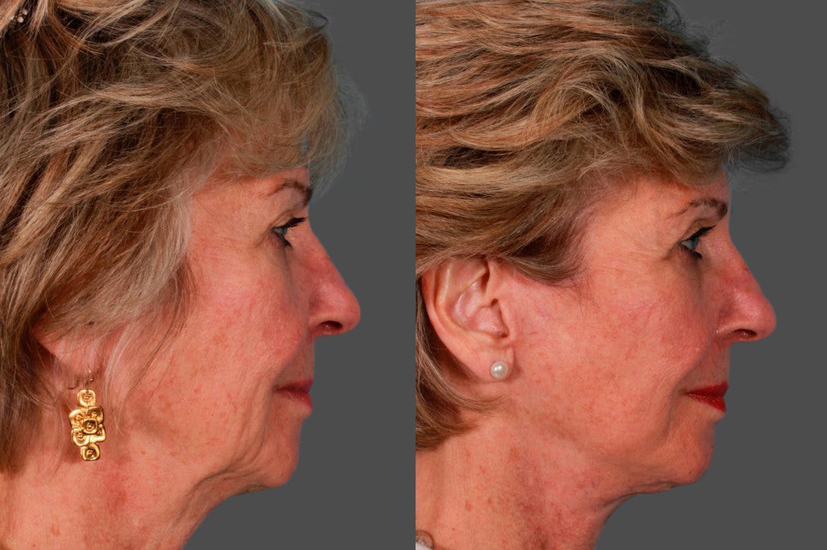 Facelift Before & After Gallery - Patient 181736 - Image 2
