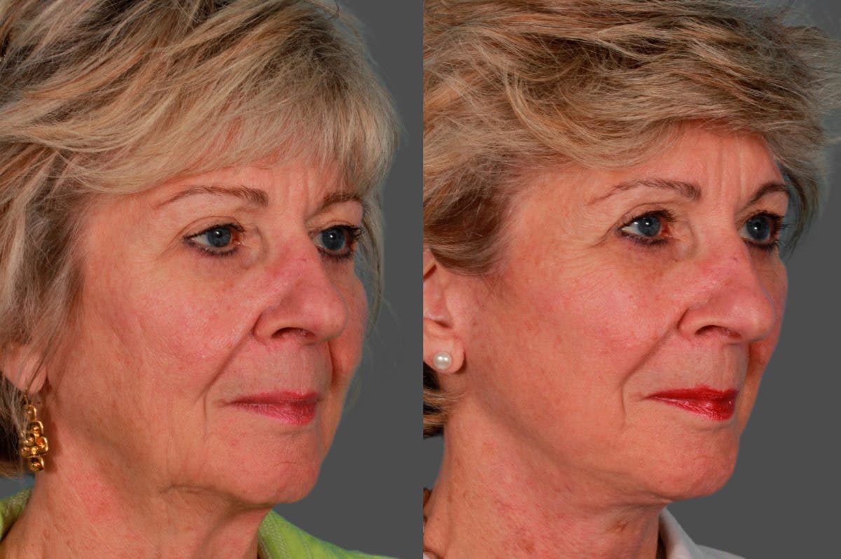 Facelift Before & After Gallery - Patient 181736 - Image 3