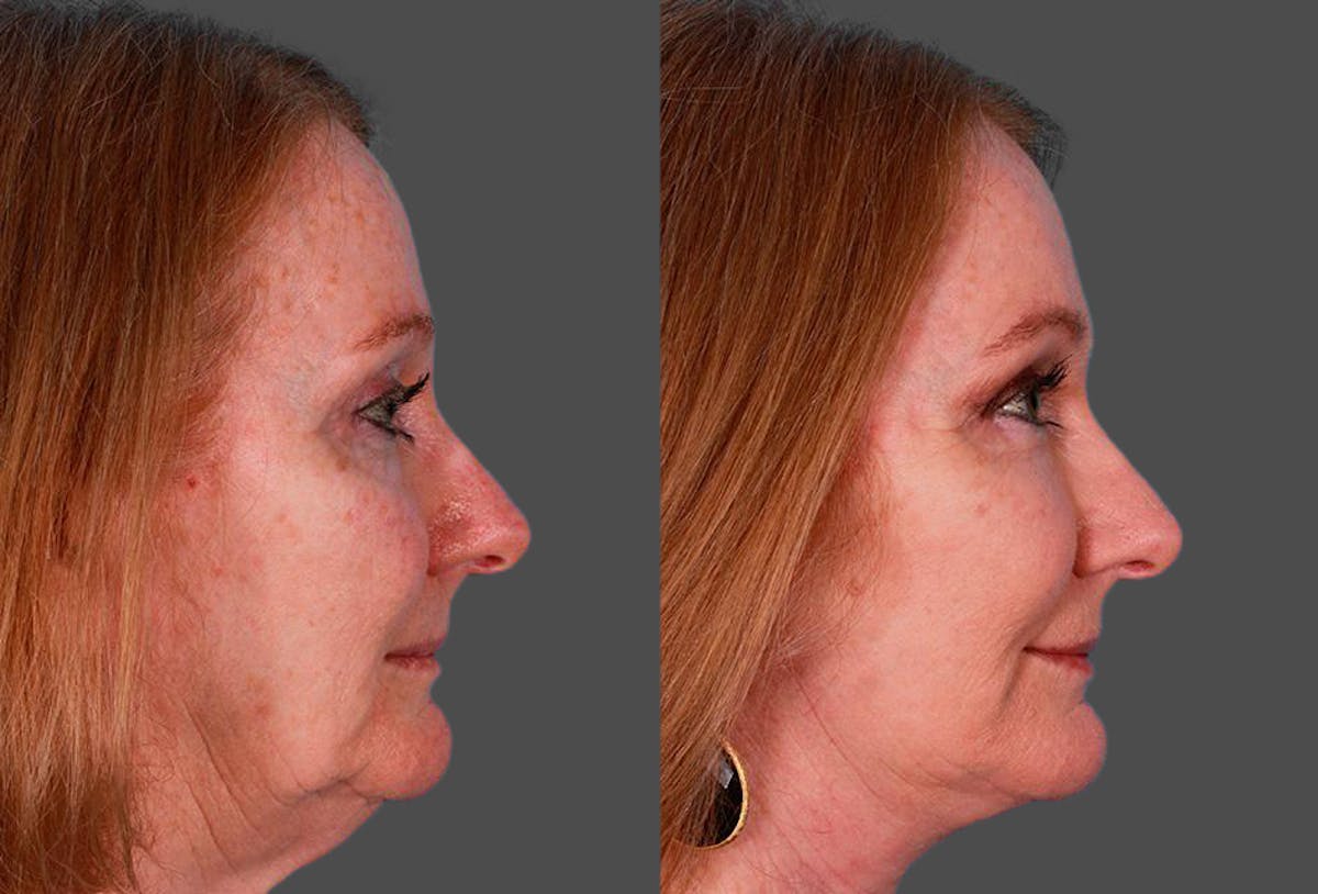 Facelift Before & After Gallery - Patient 181414 - Image 3